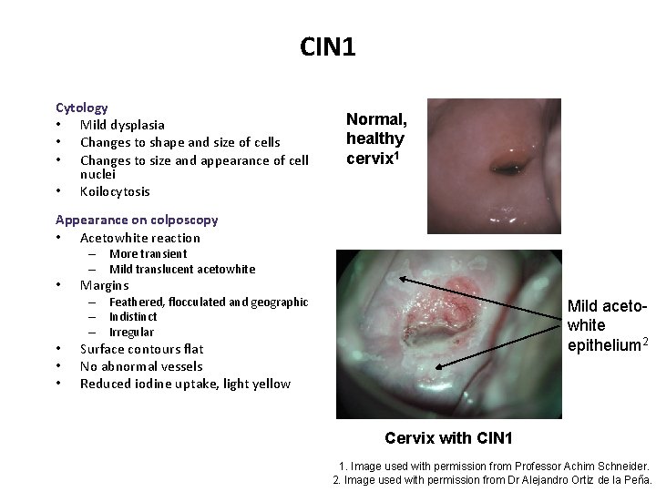 CIN 1 Cytology • Mild dysplasia • Changes to shape and size of cells