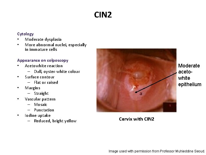 CIN 2 Cytology • Moderate dysplasia • More abnormal nuclei, especially in immature cells