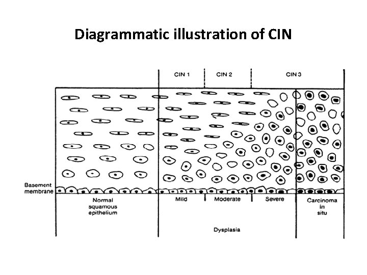 Diagrammatic illustration of CIN 