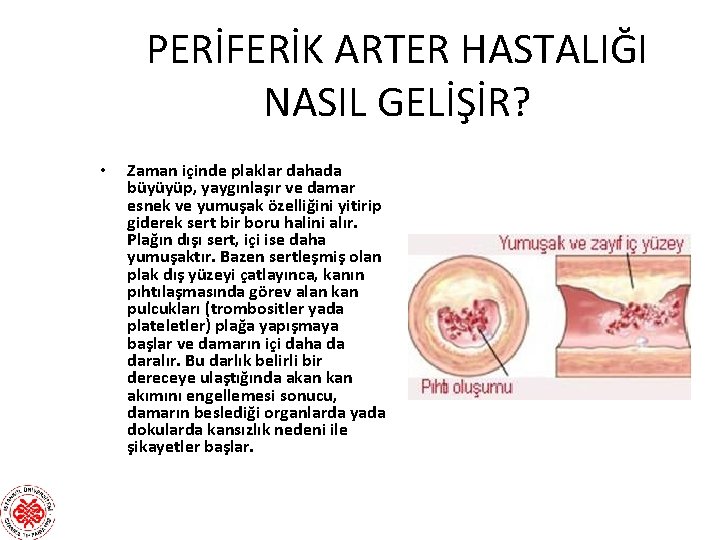 PERİFERİK ARTER HASTALIĞI NASIL GELİŞİR? • Zaman içinde plaklar dahada büyüyüp, yaygınlaşır ve damar