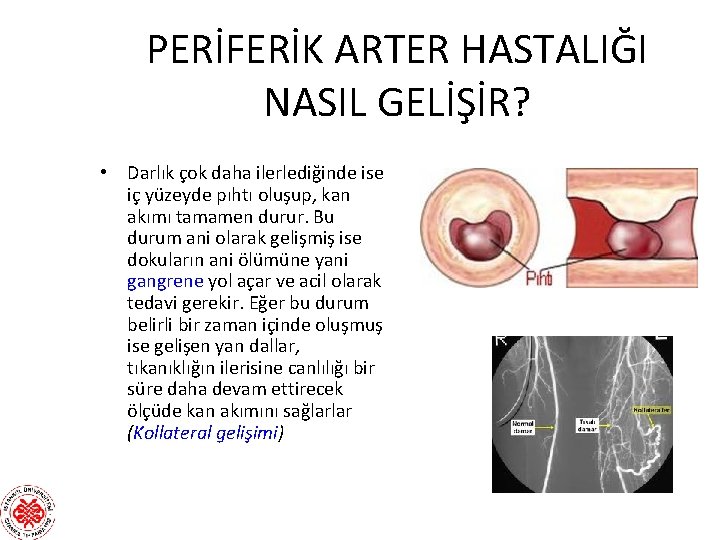 PERİFERİK ARTER HASTALIĞI NASIL GELİŞİR? • Darlık çok daha ilerlediğinde ise iç yüzeyde pıhtı