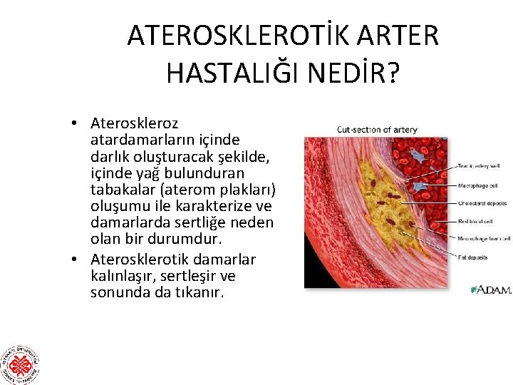 ATEROSKLEROTİK ARTER HASTALIĞI NEDİR? • Ateroskleroz atardamarların içinde darlık oluşturacak şekilde, içinde yağ bulunduran