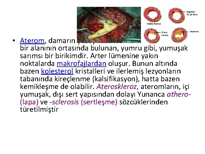 ATEROM • Aterom, damarın yüzey tabakası kalınlaşmış büyük bir alanının ortasında bulunan, yumru gibi,