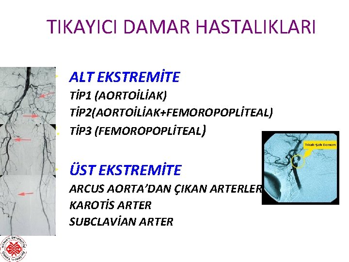 TIKAYICI DAMAR HASTALIKLARI Ø ALT EKSTREMİTE i. TİP 1 (AORTOİLİAK) ii. TİP 2(AORTOİLİAK+FEMOROPOPLİTEAL) iii.