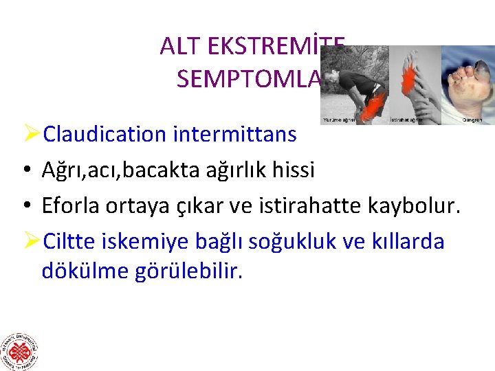 ALT EKSTREMİTE SEMPTOMLARI ØClaudication intermittans • Ağrı, acı, bacakta ağırlık hissi • Eforla ortaya