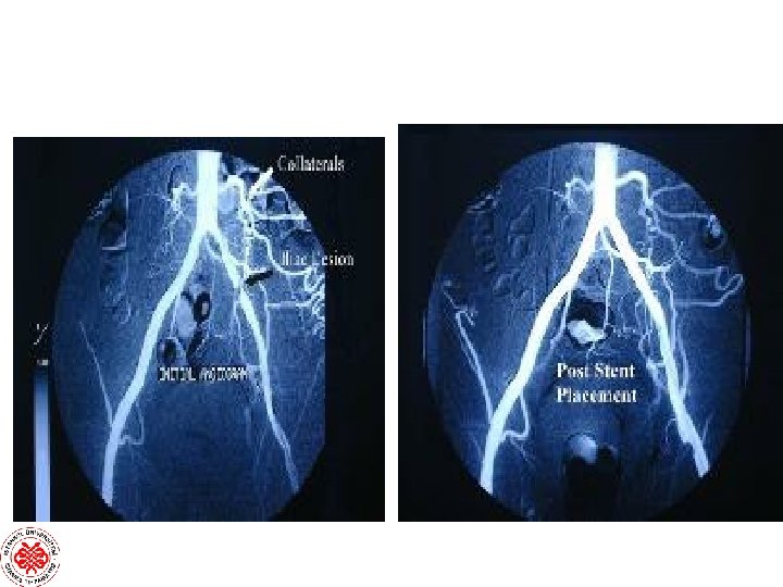 İLİAC PTA STENT 