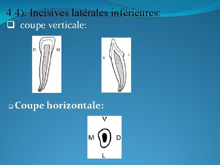 4. 4): Incisives latérales inférieures: q coupe verticale: q Coupe horizontale: 