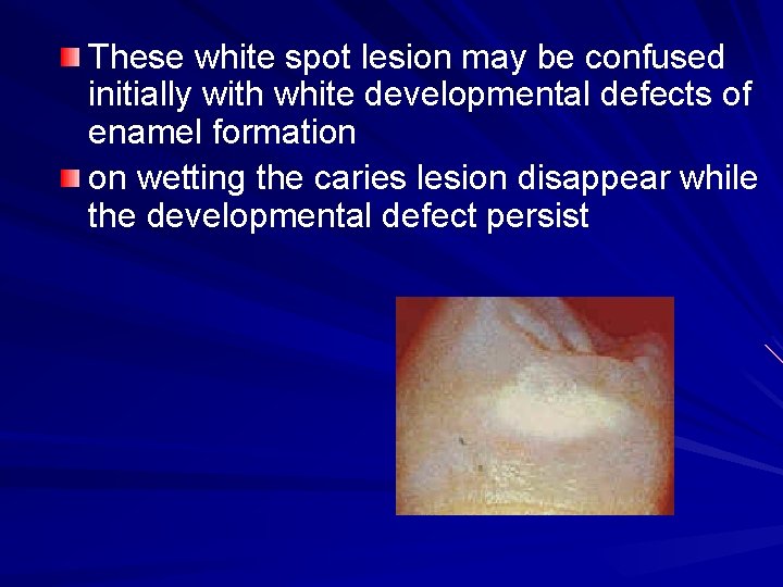 These white spot lesion may be confused initially with white developmental defects of enamel