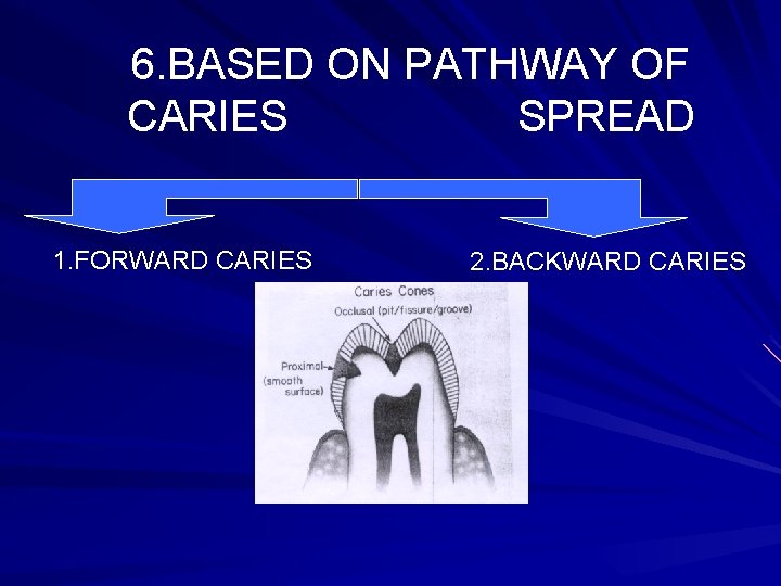 6. BASED ON PATHWAY OF CARIES SPREAD 1. FORWARD CARIES 2. BACKWARD CARIES 