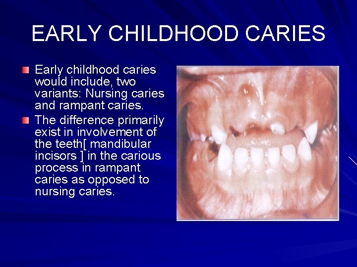 EARLY CHILDHOOD CARIES Early childhood caries would include, two variants: Nursing caries and rampant