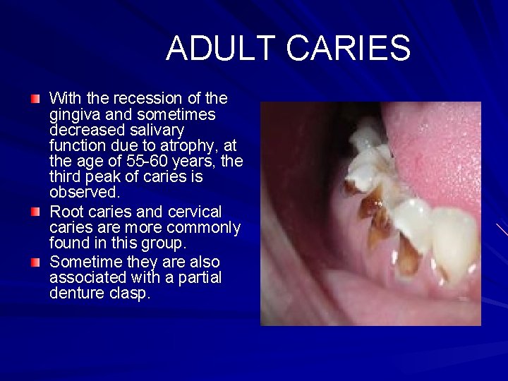 ADULT CARIES With the recession of the gingiva and sometimes decreased salivary function due