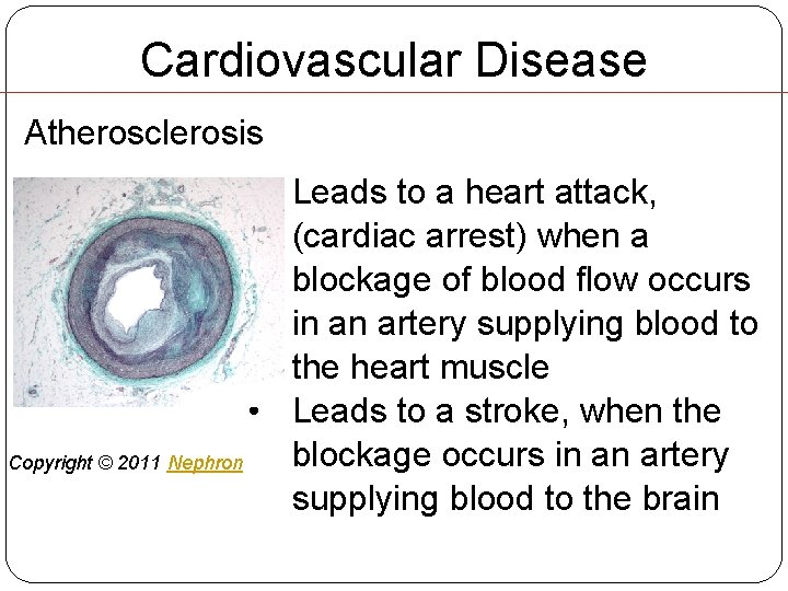 Cardiovascular Disease Atherosclerosis • Leads to a heart attack, (cardiac arrest) when a blockage Cardiovascular Disease Atherosclerosis • Leads to a heart attack, (cardiac arrest) when a blockage