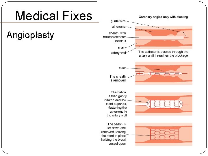 Medical Fixes Angioplasty Medical Fixes Angioplasty