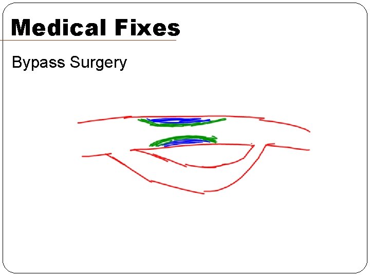 Medical Fixes Bypass Surgery Medical Fixes Bypass Surgery