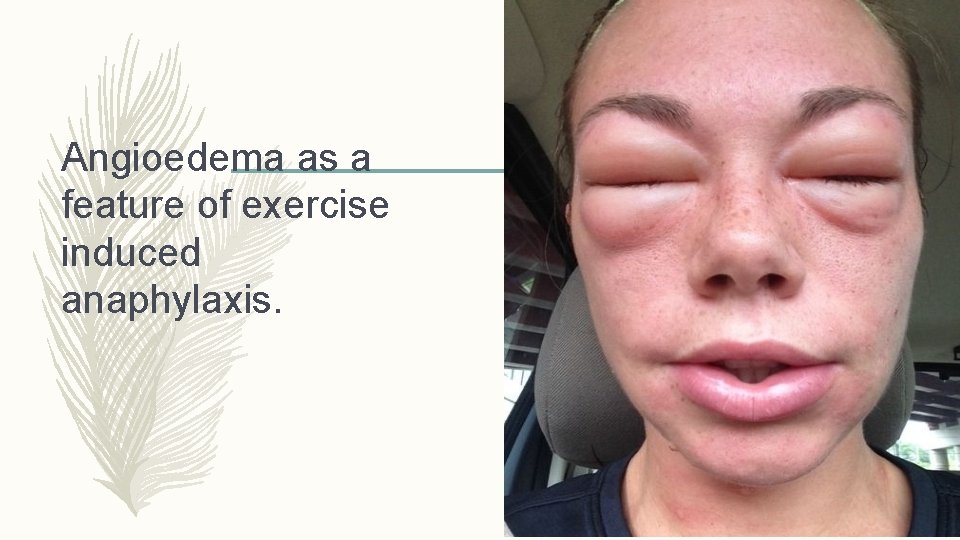 ANAPHYLAXIS AND URTICARIA GROUP 1 SOMADINA STANLEY OGHOGHORIE