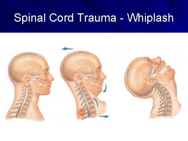 Spinal Cord Trauma - Whiplash 