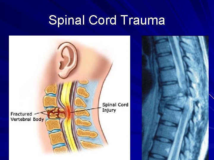 Spinal Cord Trauma 