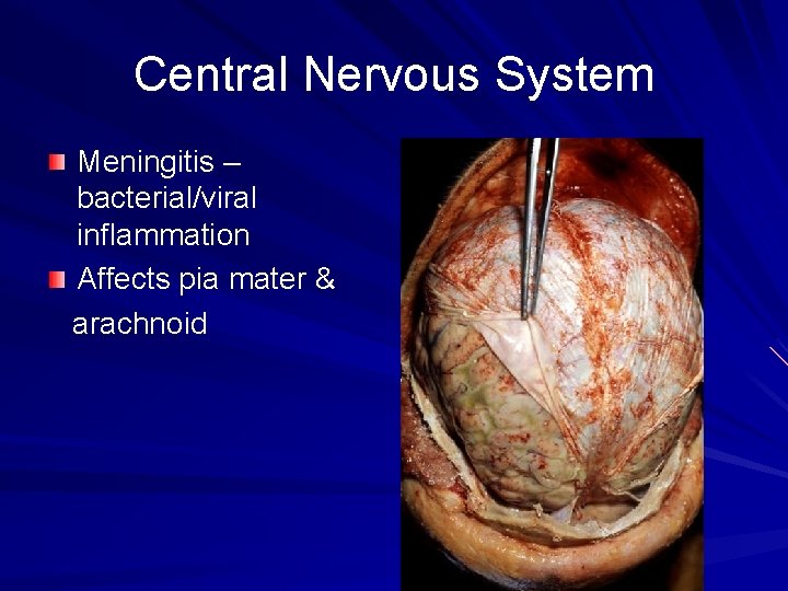 Central Nervous System Meningitis – bacterial/viral inflammation Affects pia mater & arachnoid 