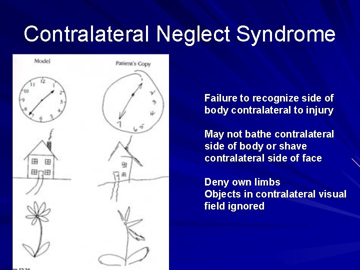 Contralateral Neglect Syndrome Failure to recognize side of body contralateral to injury May not