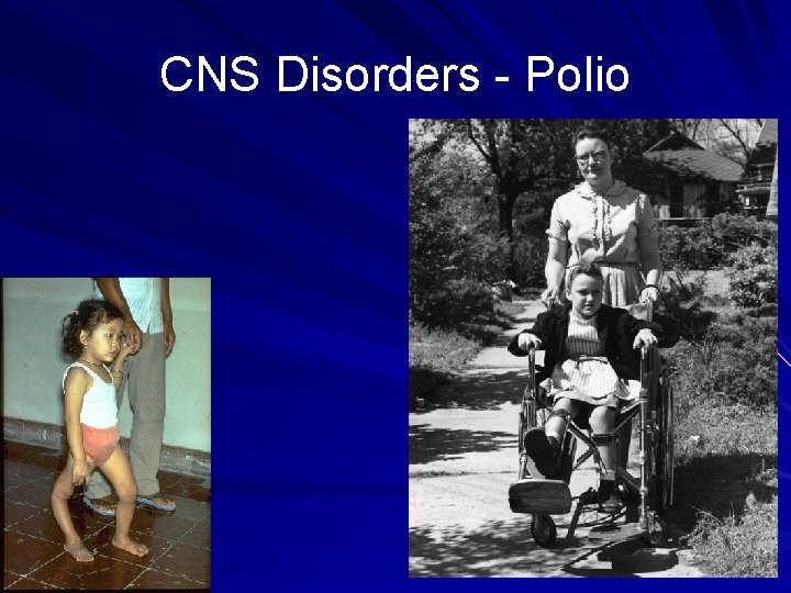 CNS Disorders - Polio 