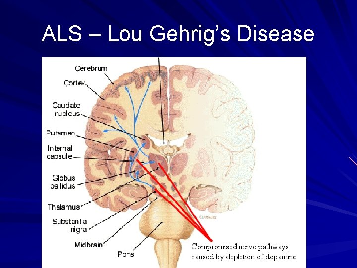 ALS – Lou Gehrig’s Disease 