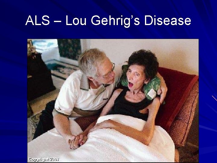 ALS – Lou Gehrig’s Disease 