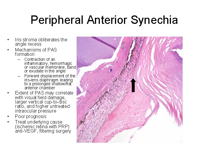 Peripheral Anterior Synechia • • Iris stroma obliterates the angle recess Mechanisms of PAS
