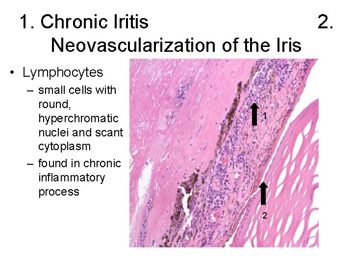 1. Chronic Iritis 2. Neovascularization of the Iris • Lymphocytes – small cells with