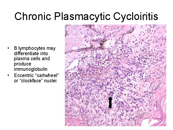 Chronic Plasmacytic Cycloiritis • B lymphocytes may differentiate into plasma cells and produce immunoglobulin