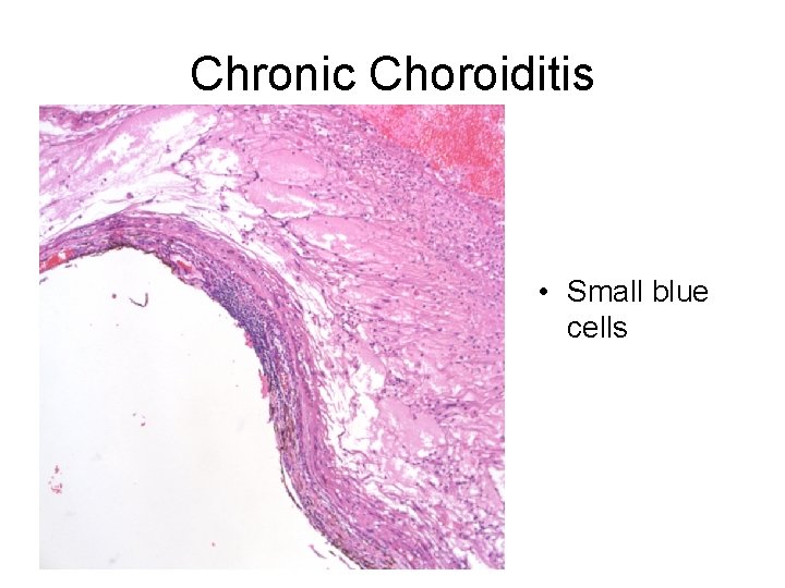 Chronic Choroiditis • Small blue cells 