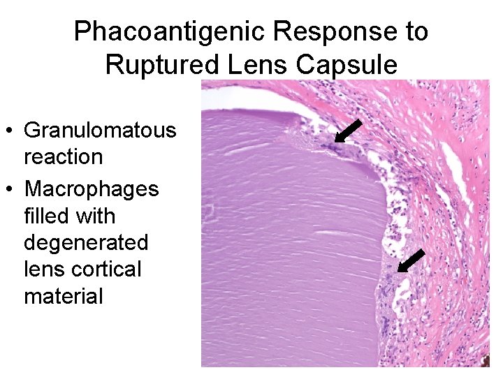 Phacoantigenic Response to Ruptured Lens Capsule • Granulomatous reaction • Macrophages filled with degenerated