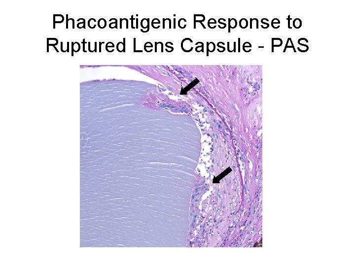 Phacoantigenic Response to Ruptured Lens Capsule - PAS 