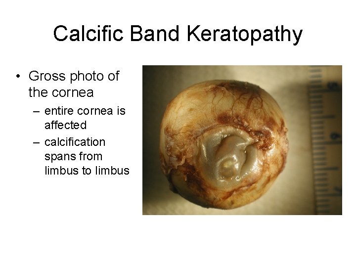 Calcific Band Keratopathy • Gross photo of the cornea – entire cornea is affected