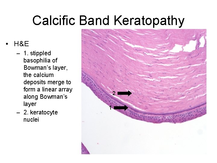 Calcific Band Keratopathy • H&E – 1. stippled basophilia of Bowman’s layer, the calcium