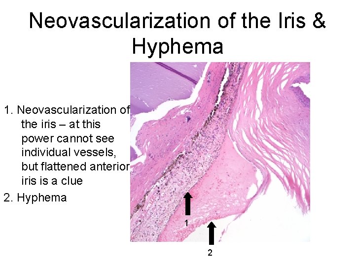 Neovascularization of the Iris & Hyphema 1. Neovascularization of the iris – at this
