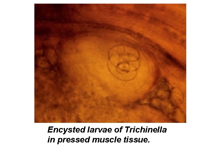 Encysted larvae of Trichinella in pressed muscle tissue. 