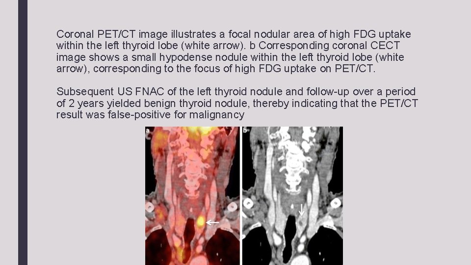 Coronal PET/CT image illustrates a focal nodular area of high FDG uptake within the