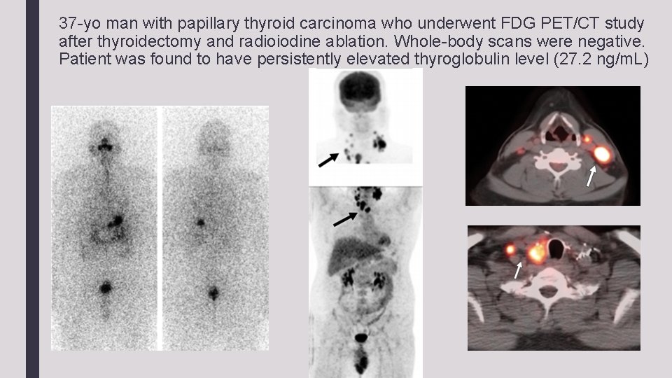 37 -yo man with papillary thyroid carcinoma who underwent FDG PET/CT study after thyroidectomy