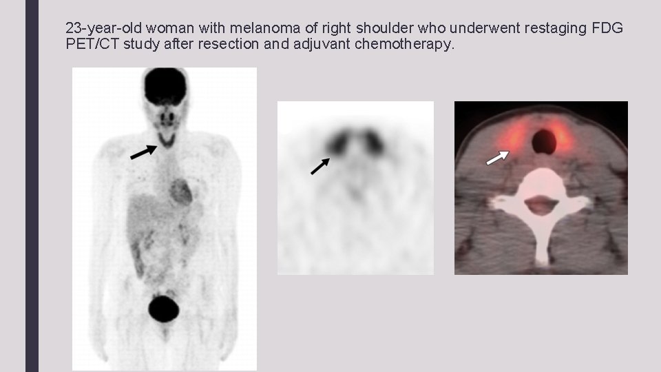 23 -year-old woman with melanoma of right shoulder who underwent restaging FDG PET/CT study