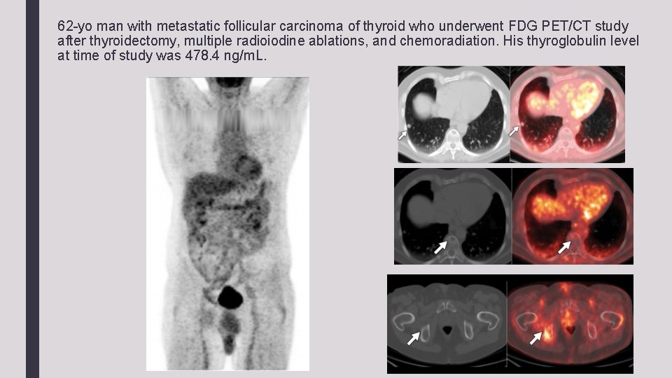 62 -yo man with metastatic follicular carcinoma of thyroid who underwent FDG PET/CT study