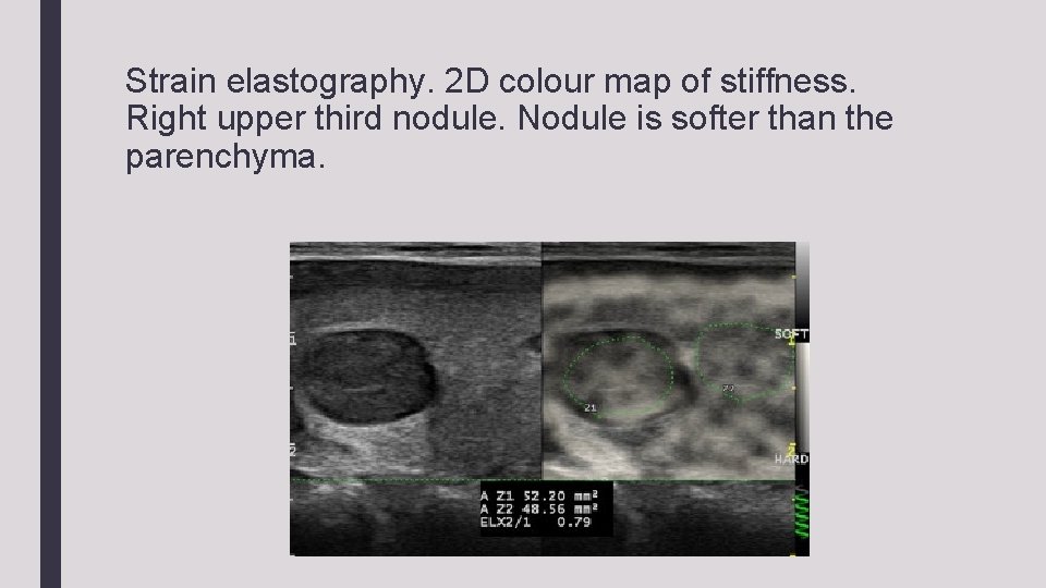 Strain elastography. 2 D colour map of stiffness. Right upper third nodule. Nodule is