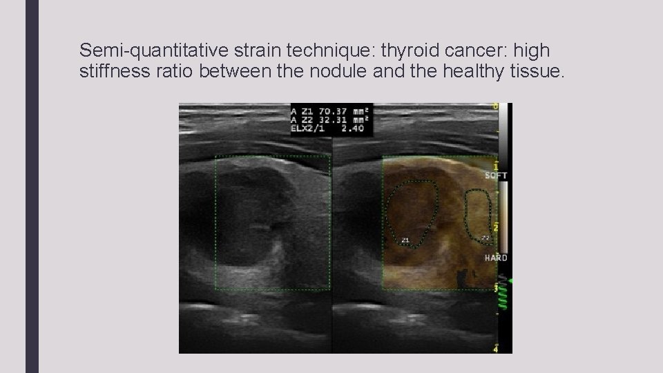 Semi-quantitative strain technique: thyroid cancer: high stiffness ratio between the nodule and the healthy