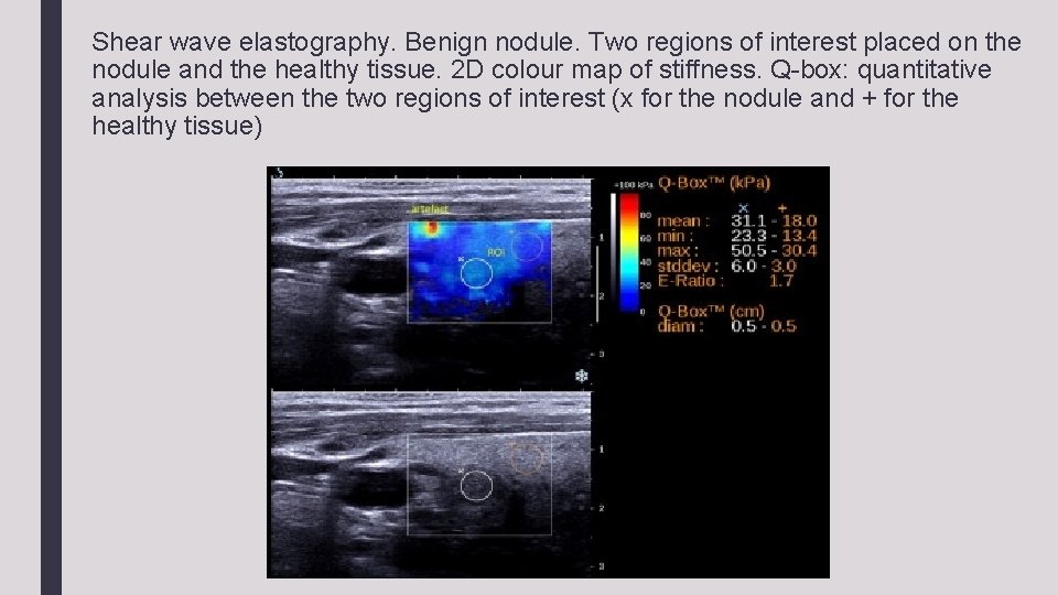 Shear wave elastography. Benign nodule. Two regions of interest placed on the nodule and