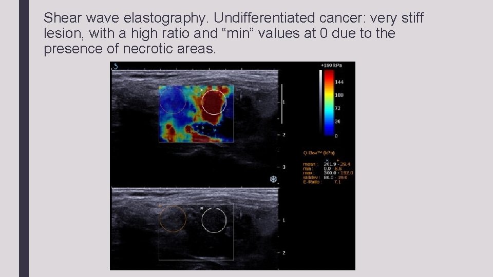 Shear wave elastography. Undifferentiated cancer: very stiff lesion, with a high ratio and “min”