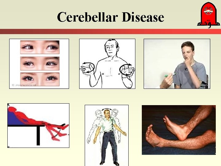 Cerebellar Disease 