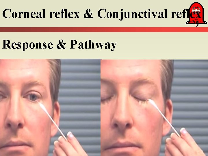 Corneal reflex & Conjunctival reflex Response & Pathway 
