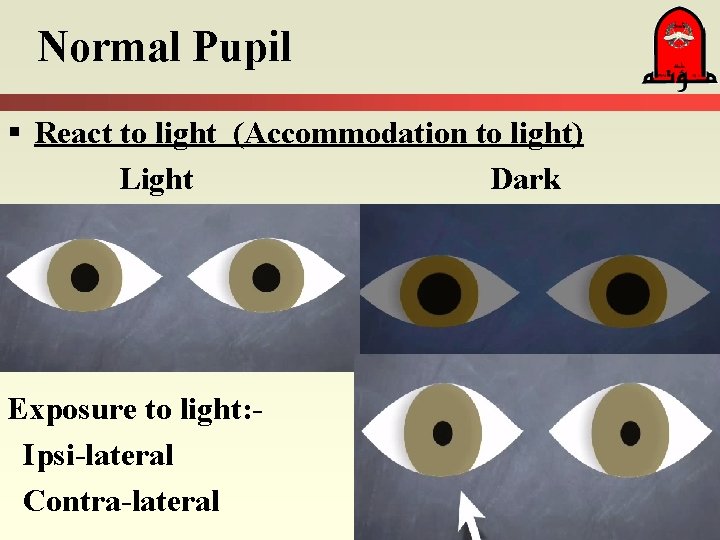 Normal Pupil § React to light (Accommodation to light) Light Dark Exposure to light: