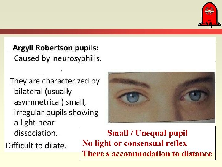 Small / Unequal pupil No light or consensual reflex There s accommodation to distance
