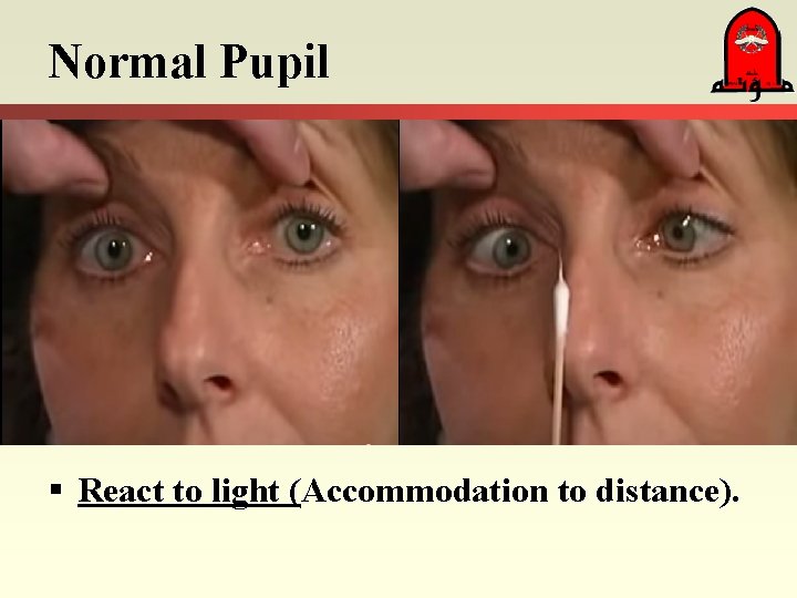 Normal Pupil § React to light (Accommodation to distance). 