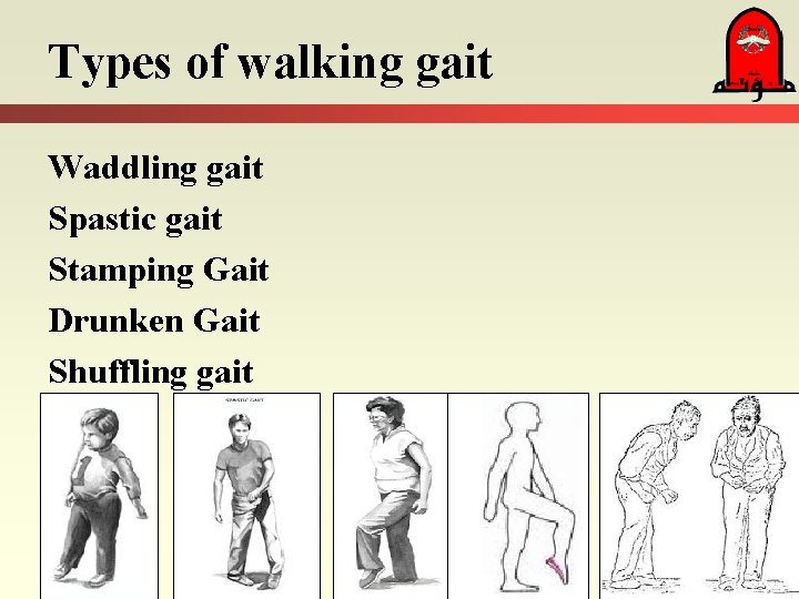 Types of walking gait Waddling gait Spastic gait Stamping Gait Drunken Gait Shuffling gait